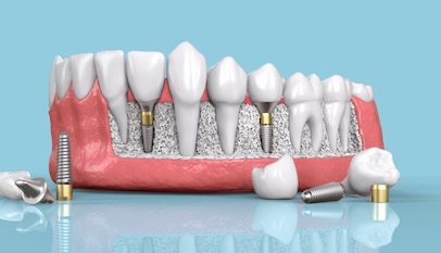 tile-dental-implants